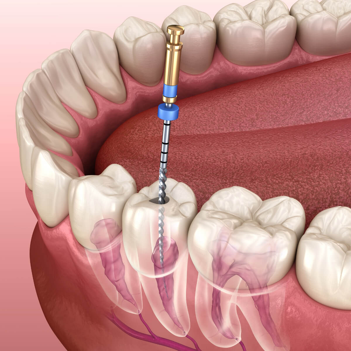 Painless Root Canal Treatment in Los Angeles CA area